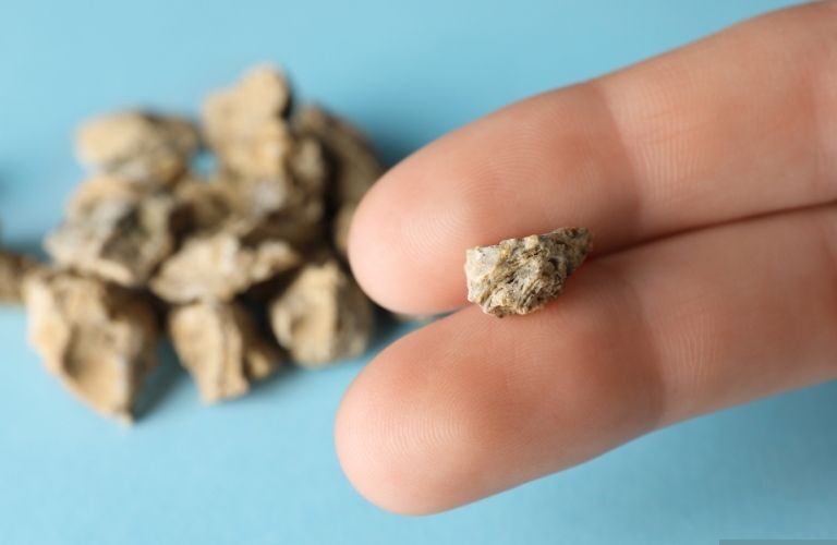 Böbrek Taşını Önlemenin 10 Yolu